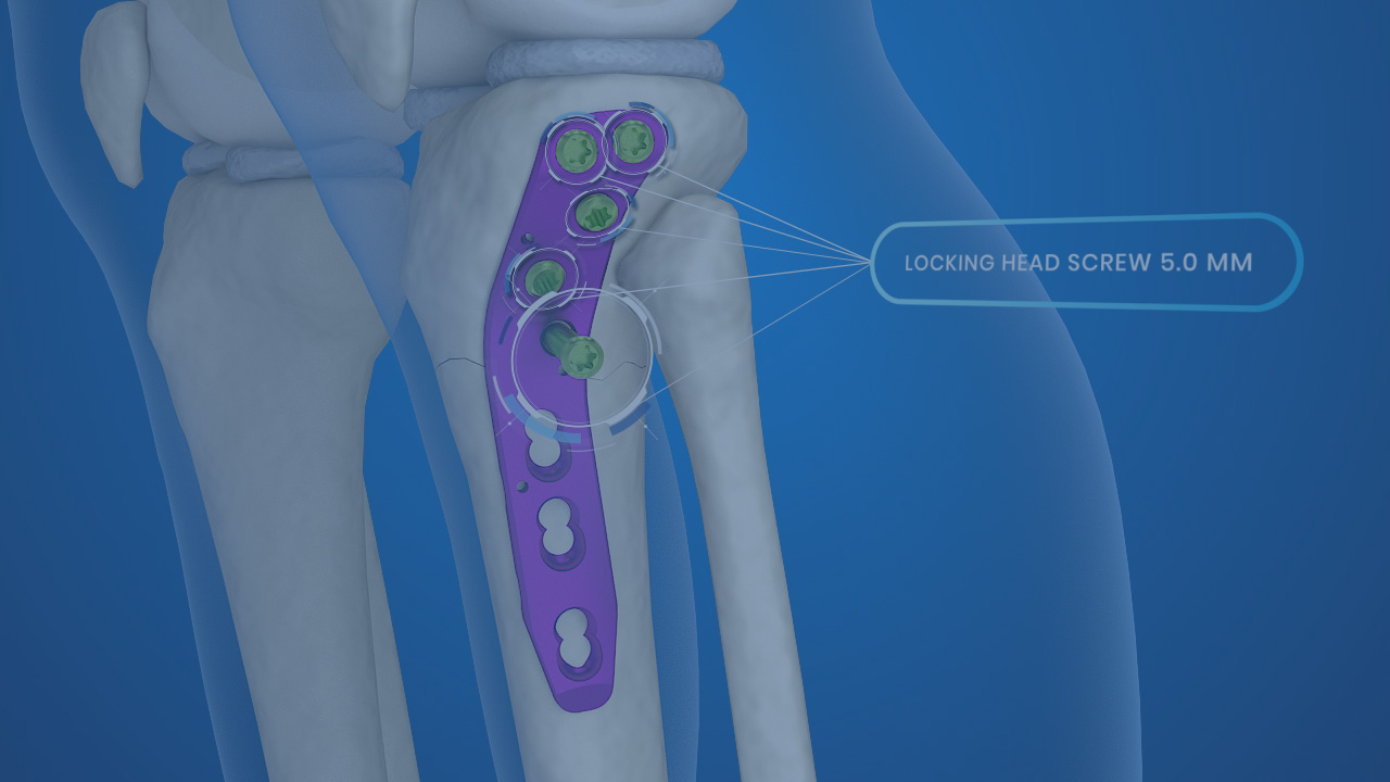 proximal lateral tibia